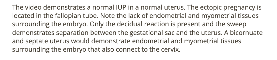 <p>b) heterotropic pregnancy</p>