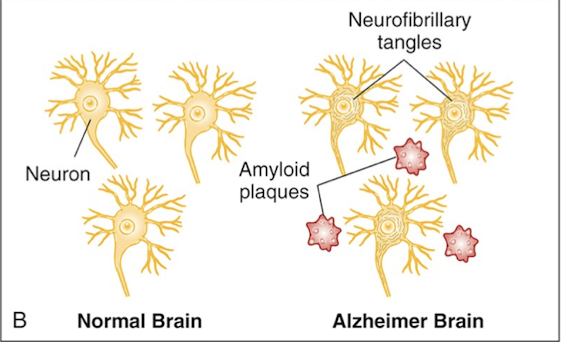 <ul><li><p>Extracellular deposition of β-amyloid (Senile neuritic plaques)</p></li><li><p>Intracellular accumulation of tau protein (Neurofibrillary tangles)</p></li></ul>