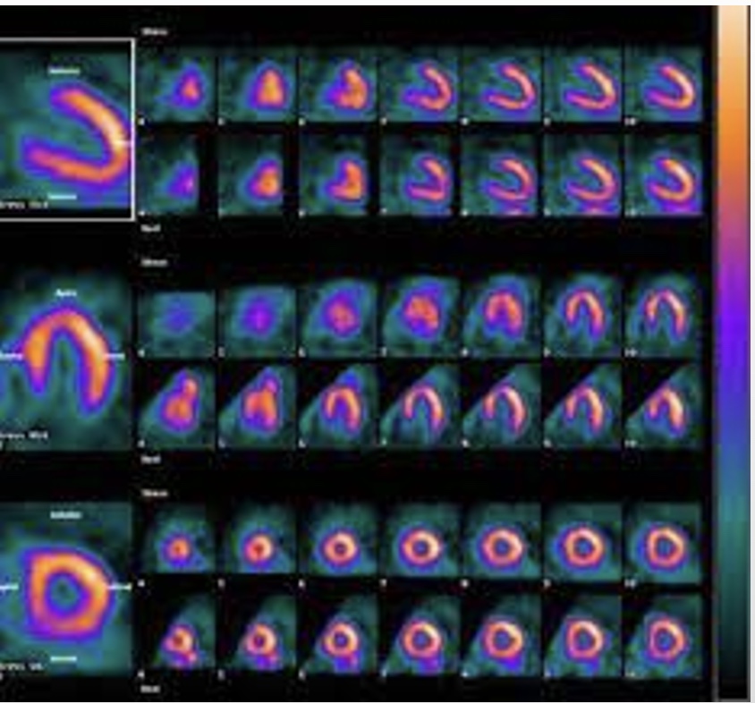 <p>*Nuclear study; picture of left ventricle, yellow=great profusion, dark=no blood flow</p><p><span style="font-family: &quot;Franklin Gothic Medium&quot;;">-When the resting ECG is abnormal, exercise testing may be coupled with other techniques designed to either augment or replace the ECG when resting abnormalities make evaluation of changes during exercise impossible.</span></p><p><span style="font-family: &quot;Franklin Gothic Medium&quot;;">-Myocardial perfusion imaging can be performed with a variety of agents and imaging approaches, although the two most common isotopes are <sup>201</sup></span><span>thallium and </span><span style="font-family: &quot;Franklin Gothic Medium&quot;;"><sup>199m</sup></span><span>technetium </span><span style="font-family: &quot;Franklin Gothic Medium&quot;;">sestamibi, also known as Cardiolite.</span></p>