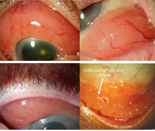 <ol><li><p>• Diffuse, slightly elevated, fleshy pink mass</p><ol><li><p> •<strong><u> Salmon patch </u></strong></p></li><li><p><strong><u>• “Chemotic”</u></strong> appearance </p><ol><li><p>• Mimics inflammatory conjunctivitis </p></li></ol></li></ol></li><li><p>• Most often smooth but follicular subtype has multinodular appearance </p></li><li><p>• Location: </p><ol><li><p>• More common: Fornix, superior and inferior bulbar conjunctiva </p></li><li><p>• Less common: Limbus</p></li></ol></li></ol><p></p>