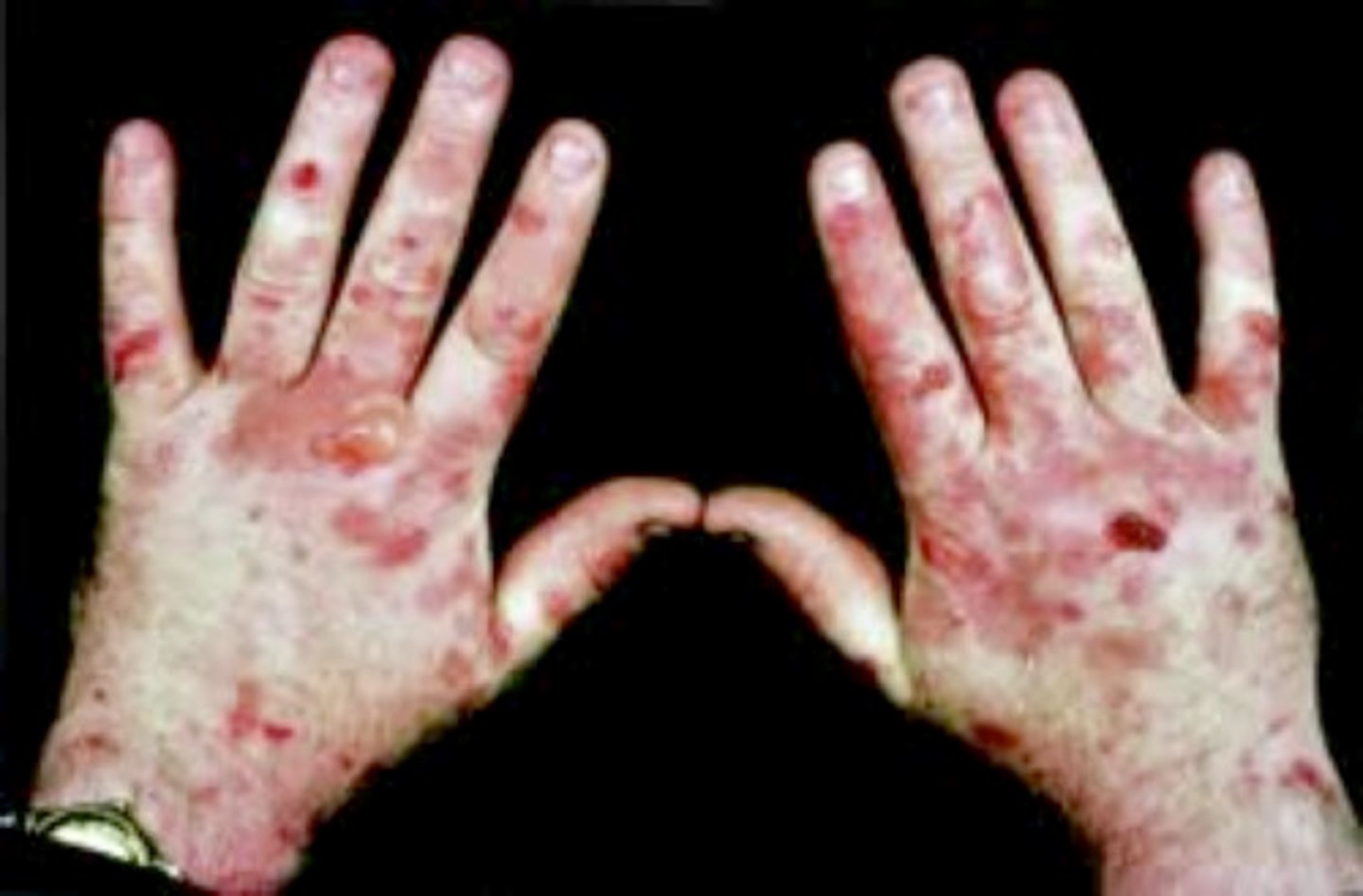 <p>Excess of the ALAS1 enzyme is produced --> accumulation of heme intermediates</p><p>severe neurological and gastrointestinal symptoms</p>