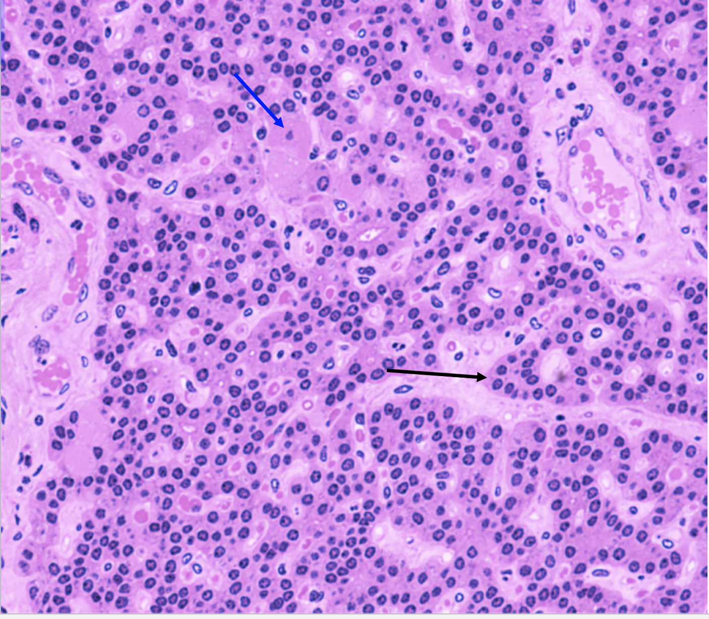 <p>In this image of the parathyroid, what does the black arrow indicate?</p>