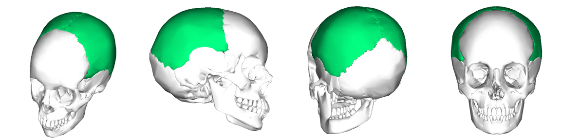 <p>Can you name what each view is of the parietal bones of the cranium?</p>