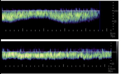 <p>What is the normal venous spectral waveform called? What is an abnormal venous spectral waveform called</p>
