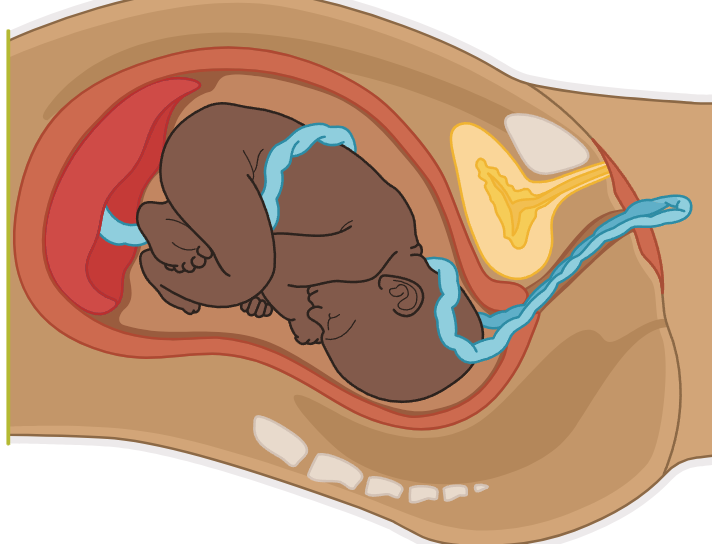 <p>Prolapsed Umbilical Cord</p>