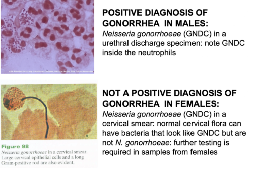 <ul><li><p><span style="background-color: transparent; font-family: "Times New Roman", serif;">Commonly used media for isolates of pathogenic neisseria is Taylor Martin (TM) agar→ Chocolate-based agar with some antimicrobics added as in VCN agar which is another similar concept that only allows pathogenic bacteria to grow&nbsp;</span></p></li><li><p><span style="background-color: transparent; font-family: "Times New Roman", serif;">VCN agar→Chocolate agar modified by addition of antibiotics: Vancomycin to inhibit gram-positive bacteria, colistin to inhibit gram-negative bacteria rods, nystatin to inhibit yeast</span></p></li><li><p><span style="background-color: transparent; font-family: "Times New Roman", serif;">Transport system specific for a neisseria such as the jembec plate system complete with CO2 generating tablets and TM plates and bag for more affordable incubation</span></p></li></ul><p><span style="background-color: transparent; font-family: "Times New Roman", serif;">Lab diag in N. gonorrheae</span></p><ul><li><p><span style="background-color: transparent; font-family: "Times New Roman", serif;">male=>urethral discharge can see gram neg diplococci and leukocytes</span></p></li><li><p><span style="background-color: transparent; font-family: "Times New Roman", serif;">female=> cervical smear with many epithelial cells, other bac similar to nisseria thus need more testing</span></p></li></ul><p></p>