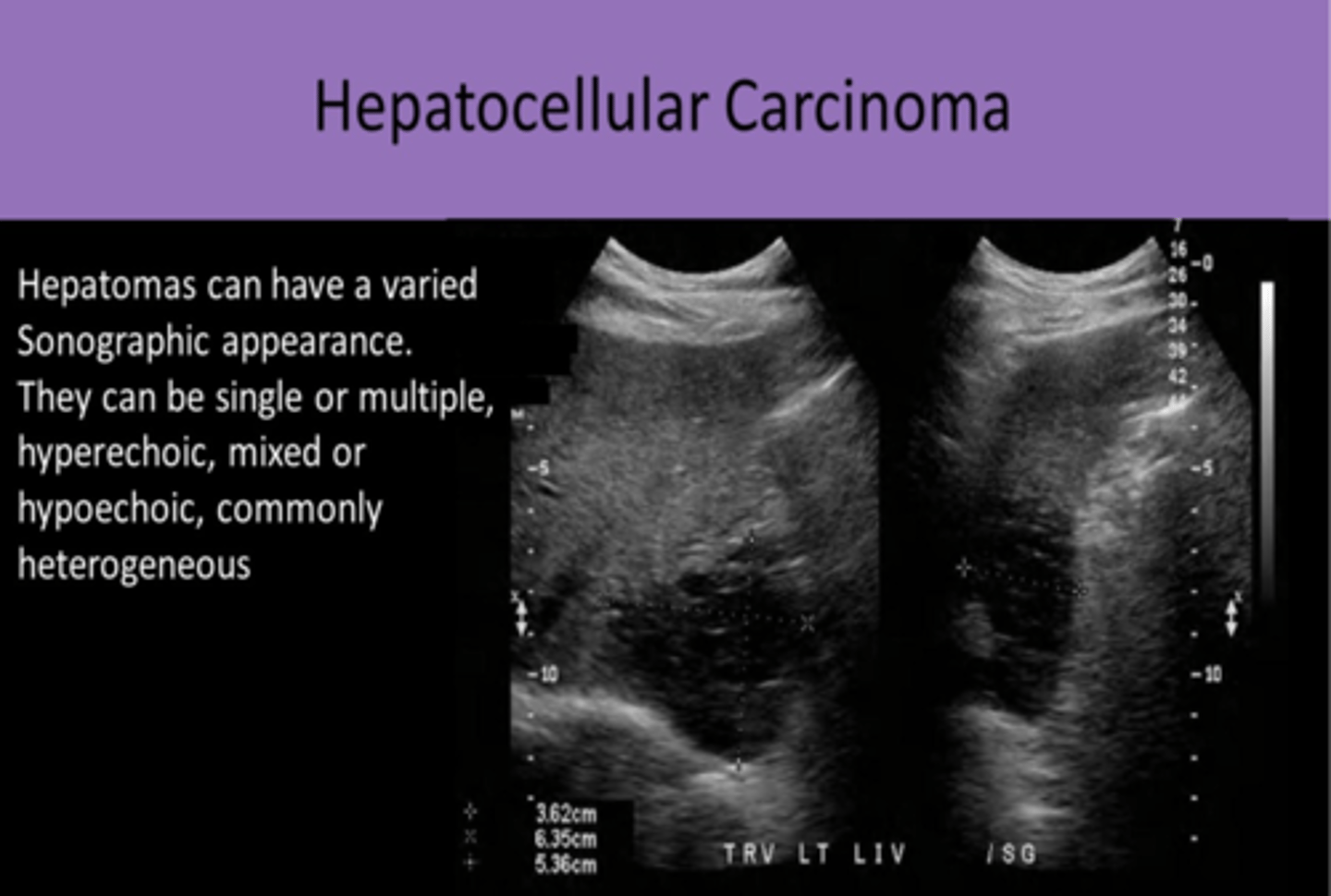 <p>1. 4TH LEADING CAUSE OF CANCER DEATH<br>2. MOST COMMON PRIMARY MALIGNANCY of THE LIVER IN ADULTS<br>3. most common RISK FACTOR IN THE US= CIRRHOSIS<br>4. 80% of patients have pre-existing cirrhosis<br>5. also associated with CHRONIC HEPATITIS<br>6. leads to HEPATOMA FORMATION<br>7. more common in MALES<br>8. common COMPLICATIONS include BILIARY OBSTRUCTION, PORTAL HYPERTENSION, AND ASCITES<br>9. INVADES VENOUS VASCULATURE (HV, PV, IVC), MOST COMMONLY PORTAL VEIN<br>10. 3-4 MONTH SURVIVAL AFTER DETECTION<br>11. 1% 5 YEAR SURVIVAL RATE</p>