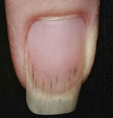 <p>= red/brown linear streaks from damage to nail bed capillaries</p><ul><li><p>occurs with bacterial endocarditis, trauma, or sport-related injury</p></li></ul>