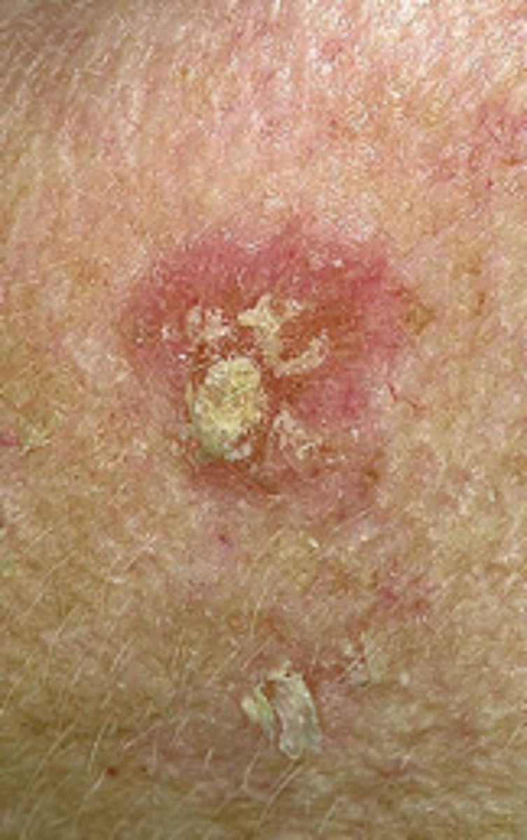 <p>Actinic Keratosis:</p><p>Superficial flattened erythematous papules covered by a dry scale</p><p>May be round or irregular</p><p>Pink or tan</p><p>Vary in size</p><p>Most common premalignant skin lesion</p><p>Responsible for 60% of Squamous Cell Carcinoma</p>