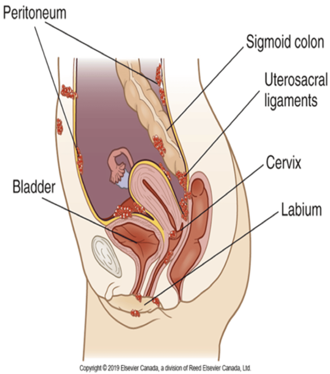<p>- presence of endometrial epithelial tissue (uterus lining) in sites outside the uterine cavity</p><p>- common sites → near ovaries, broad ligament, uterosacral ligaments, bowel/bladder</p>