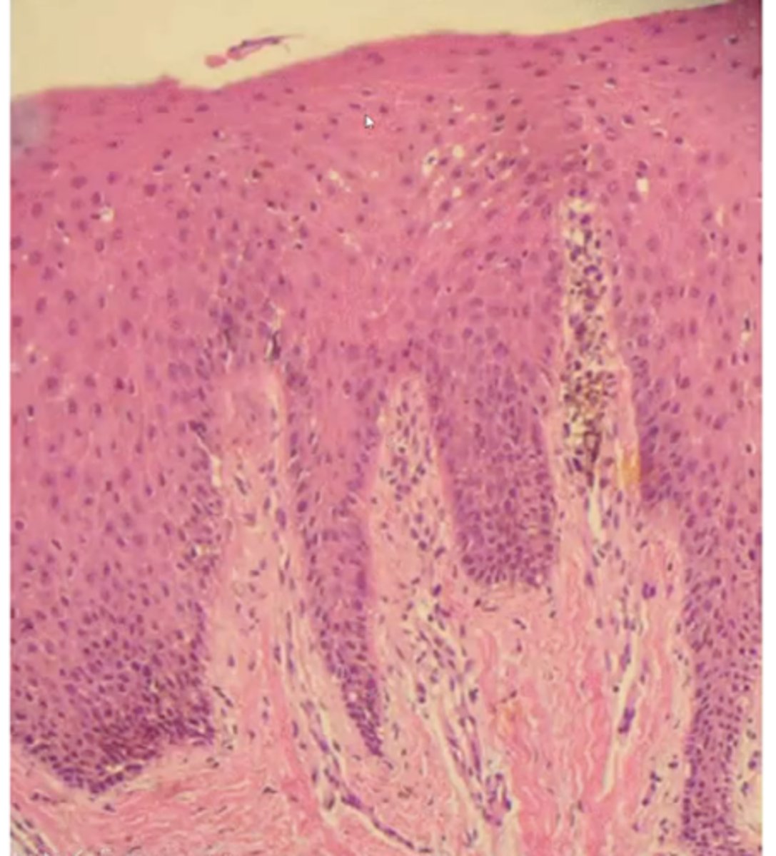<p>increased melanin in the basal layer with melanophages in the connective tissue</p><p>epithelium is normal </p>