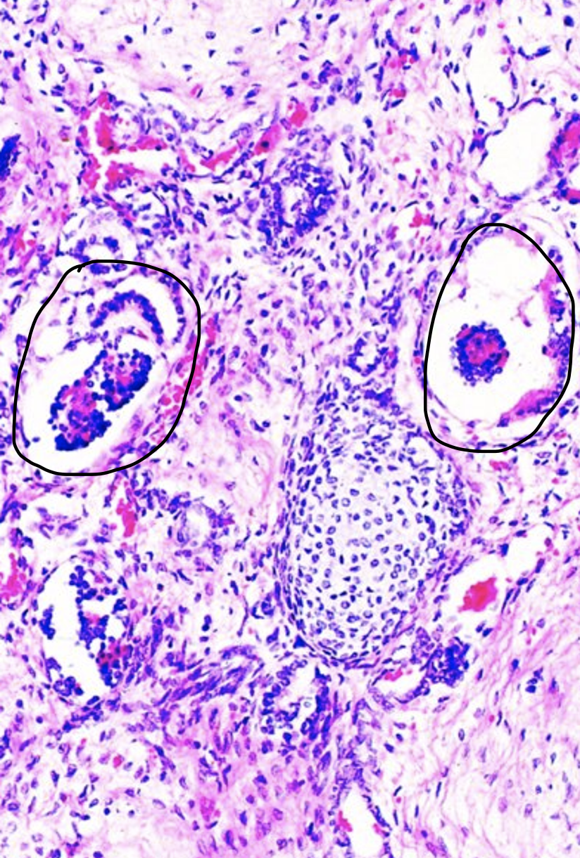 <p>Explain this histology image of renal dysplasia.</p>