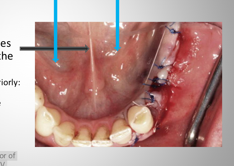 <p><span>a soft tissue ridgeon both sides of the floor of the mouth end in the caruncle, forming a V shape on the floor of the mouth. </span></p><p><span>Contains duct openings of the sublingual gland</span></p>