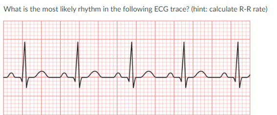 <p>JONES IN CLASS ASSIGNMENT QUESTIONS:</p><p>a. sinus tachycardia</p><p>b. atrial flutter</p><p>c. atrial fibrillation</p><p>d. PVC</p>