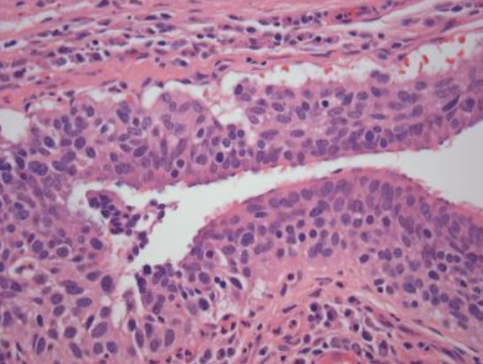 <p>Hiperplasia difusa idiopática de células <strong>neuroendocrinas</strong> pulmonares</p>