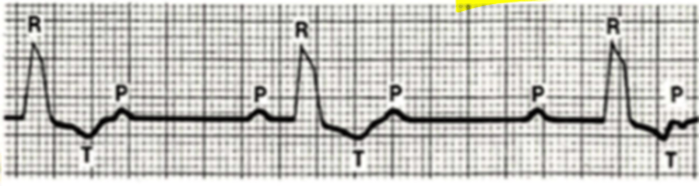 <p>Describe the EKG of lead II</p>