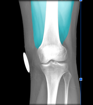 Action:
Extension of leg
Flexion of thigh at hip joint (rectus femoris only)

Innervation:
Femoral nerve