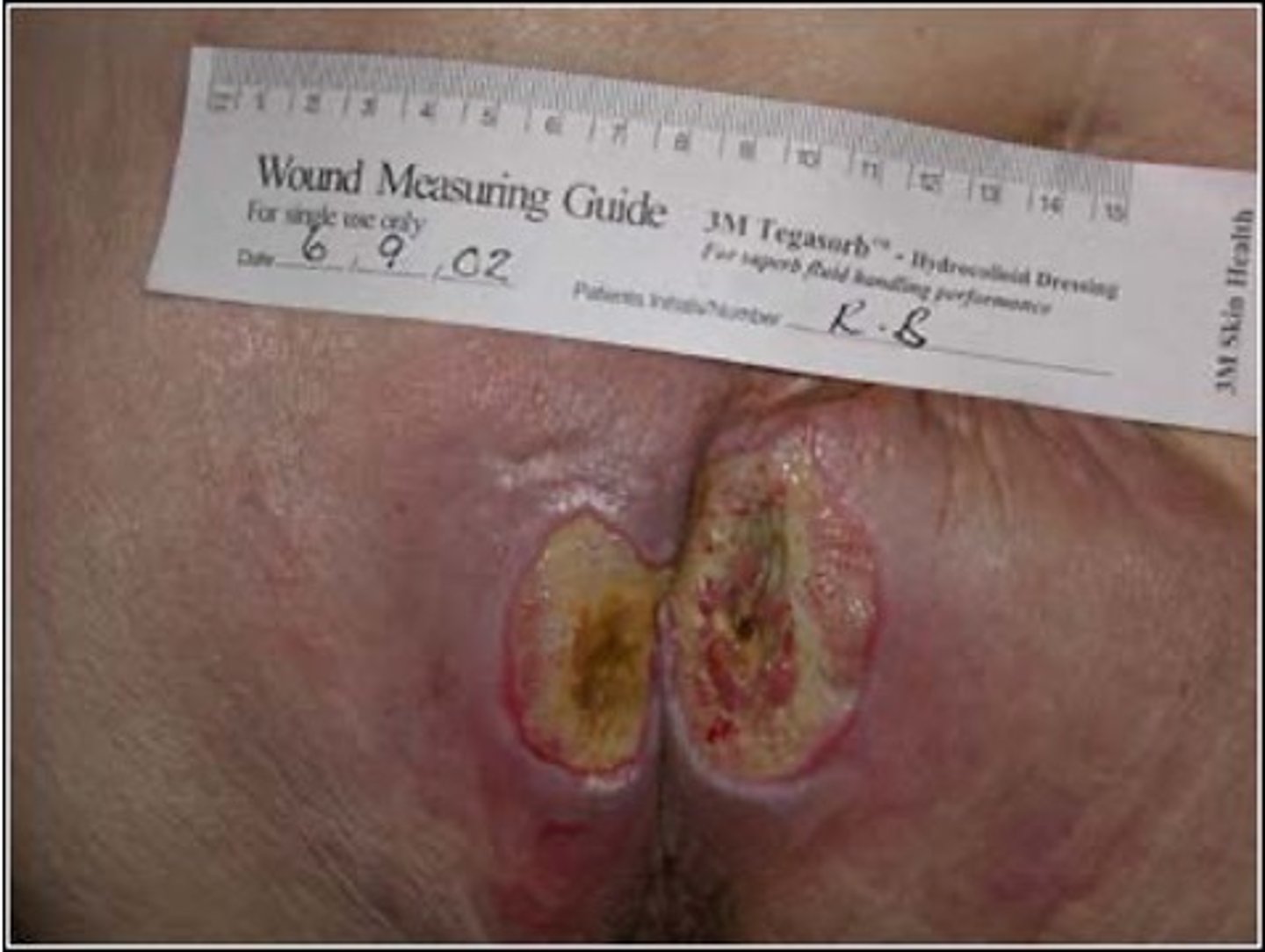 <p>Full thickness wound involving necrosis of epidermis/dermis, and extends into subcutaneous tissues</p><p>All epidermal appendages destroyed</p>