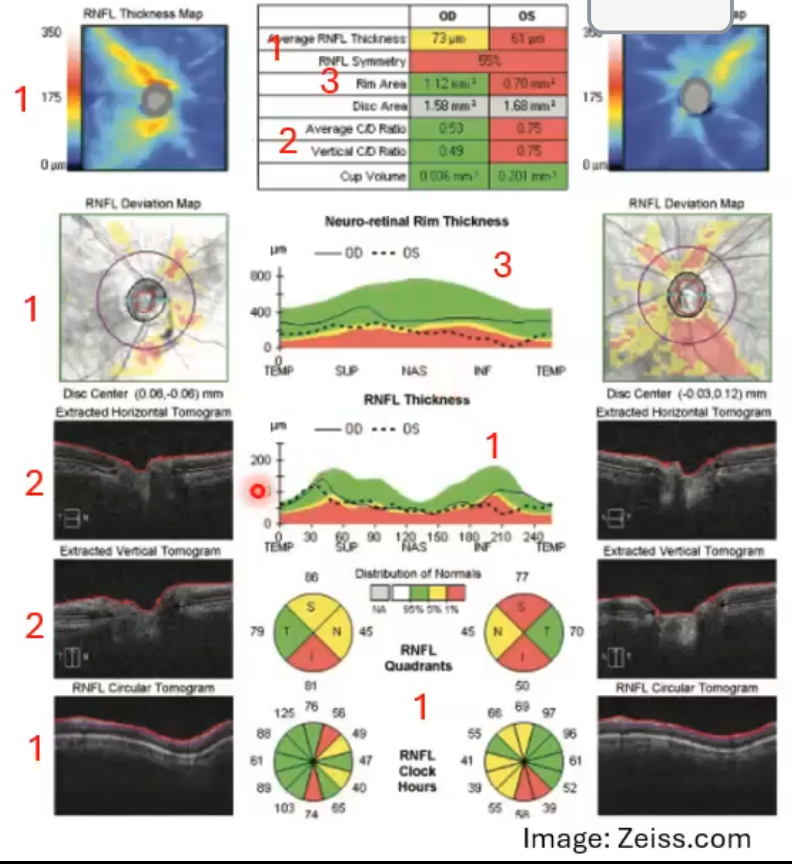 <p>key ONH/RNFL features of glaucoma </p>