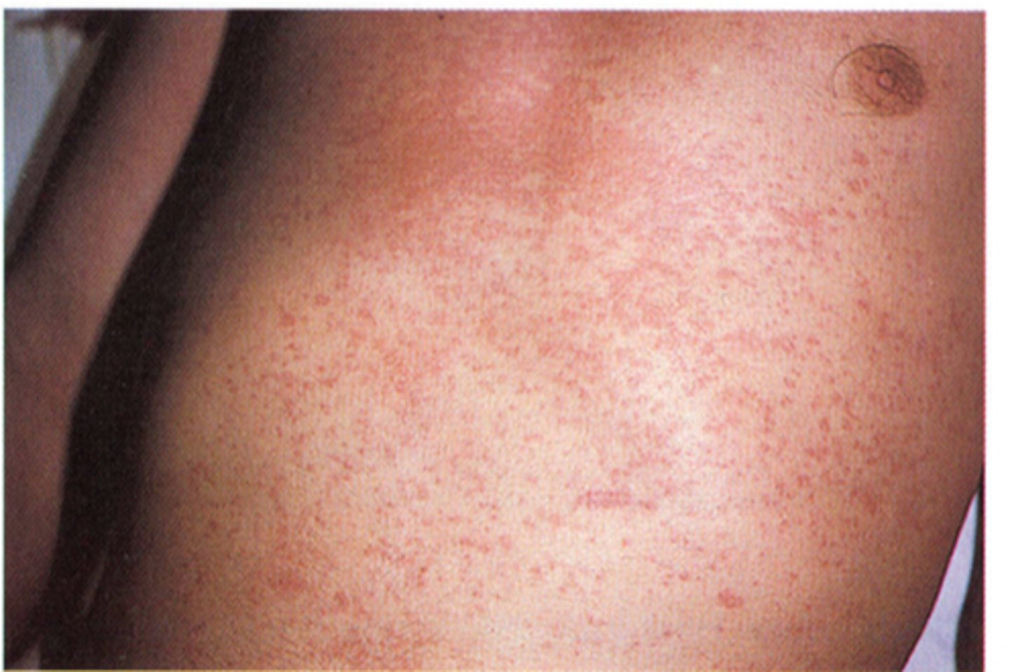 <p>Rashes that starts in the face or trunk and continue to spread</p>