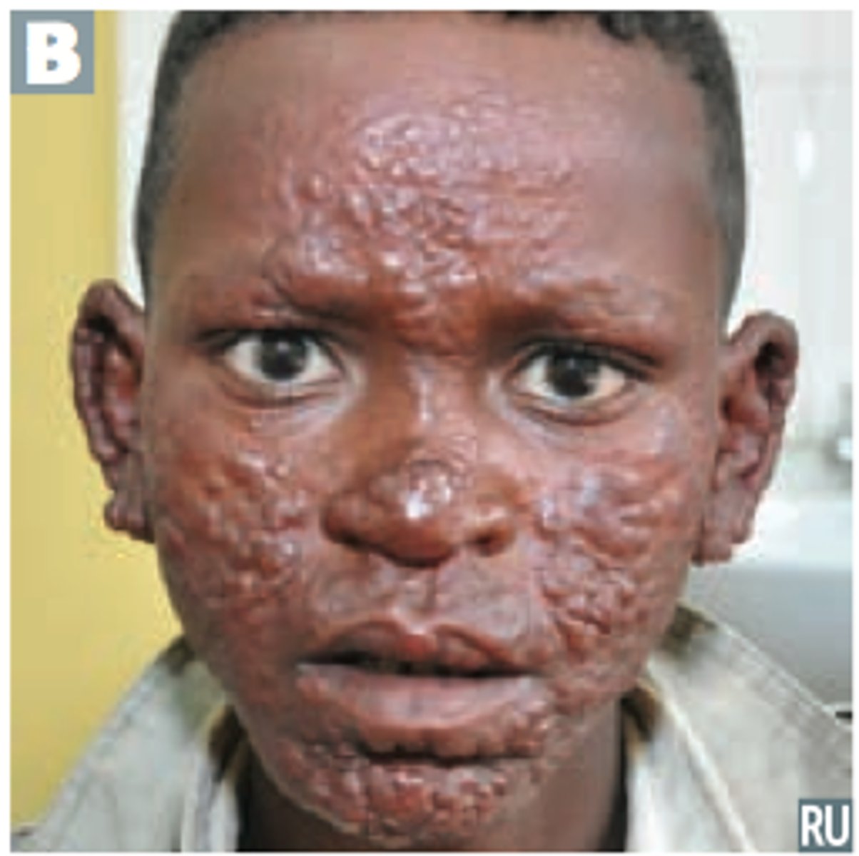 <p>Leprosy (Hansen's Disease)</p>