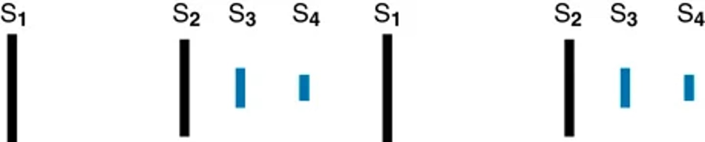 <p>The S4 is a ventricular filling sound. It occurs when the atria contract late in diastole. It is heard immediately before S1. This is a very soft sound of very low pitch.</p><p>(heard best with bell in left lateral position)</p><p>Physiological s4 -> may occur in adults older than 40 or 50 years with no evidence of cardiovascular disease, especially after exercise</p><p>Pathological s4 -> atrial gallop or an S4 gallop. It occurs with decreased compliance of the ventricle (e.g., coronary artery disease, cardiomyopathy) and systolic overload (afterload), including outflow obstruction to the ventricle (aortic stenosis) and systemic hypertension.</p><p>A left-sided S4 occurs with these conditions. It is heard best at the apex, in the left lateral position.</p><p>A right-sided S4 is less common. It is heard at the left lower sternal border and may increase with inspiration. It occurs with pulmonary stenosis or pulmonary hypertension.</p>