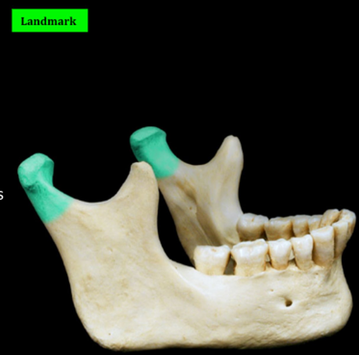 <p>Articulates with temporal bone by the temporomandibular joint</p>