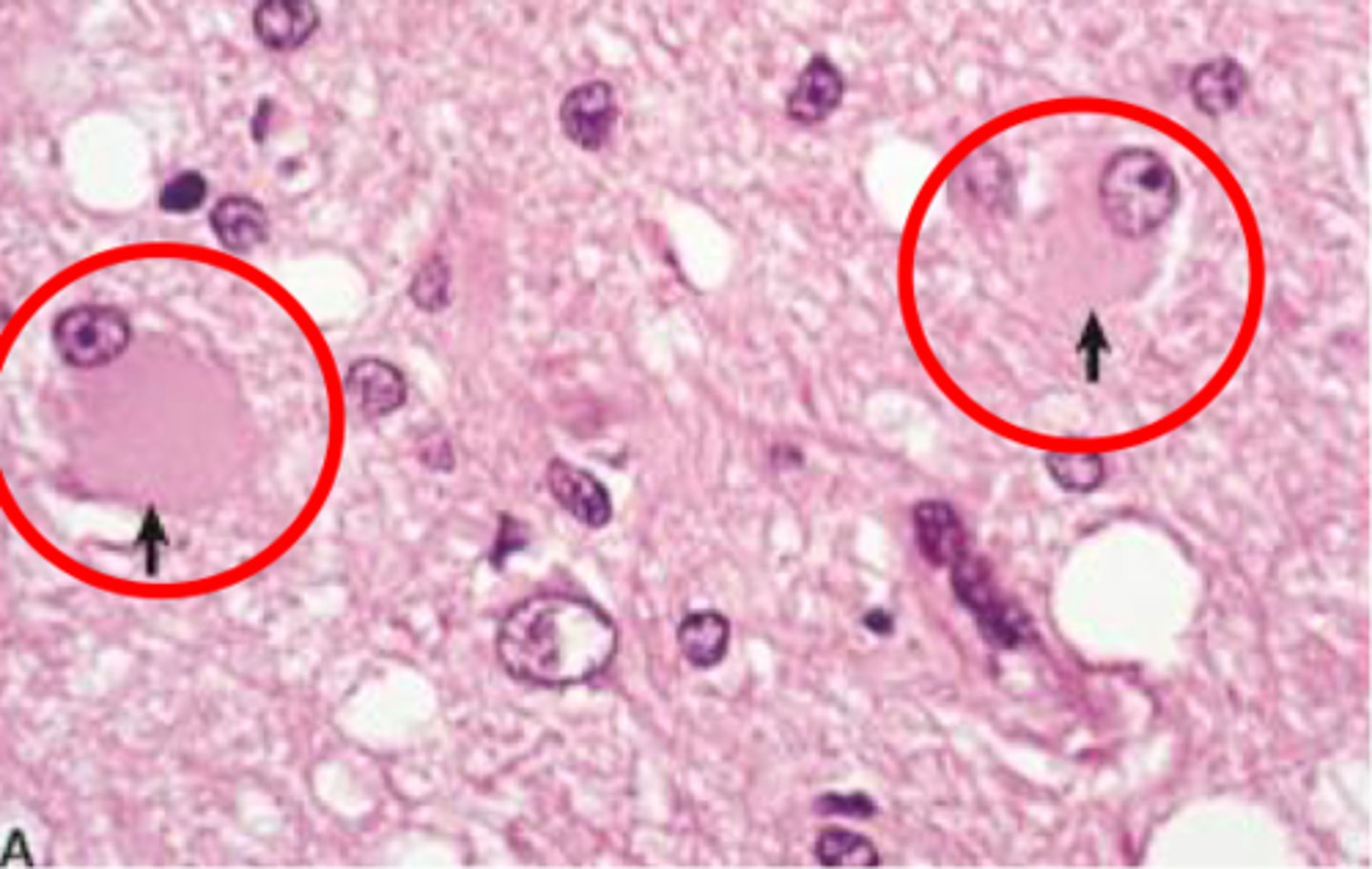 <p>astrocytes that respond to injury by increasing their cytoplasm</p>