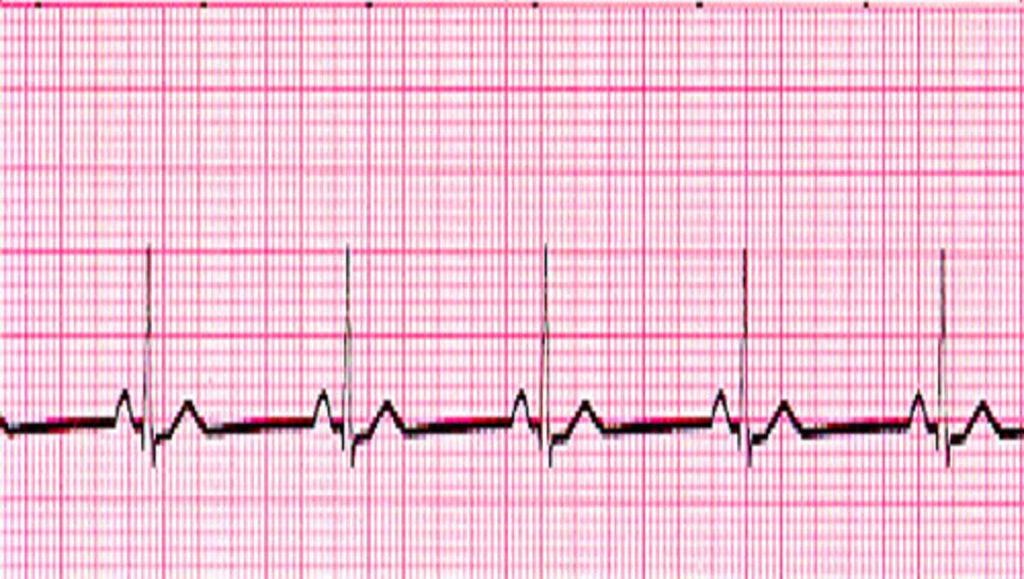 <p>What does the ECG show?</p>