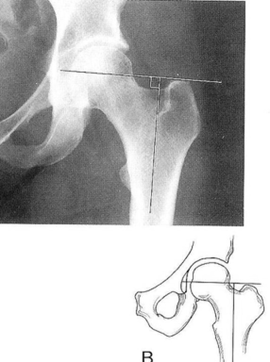 <p>ID measurement</p>
