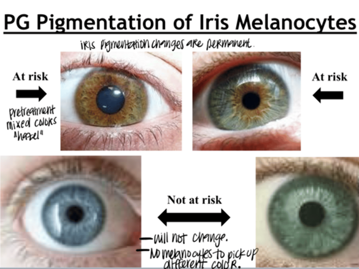 <p>Prostaglandin Pigmentation of Iris Melanocytes (Pic)</p>
