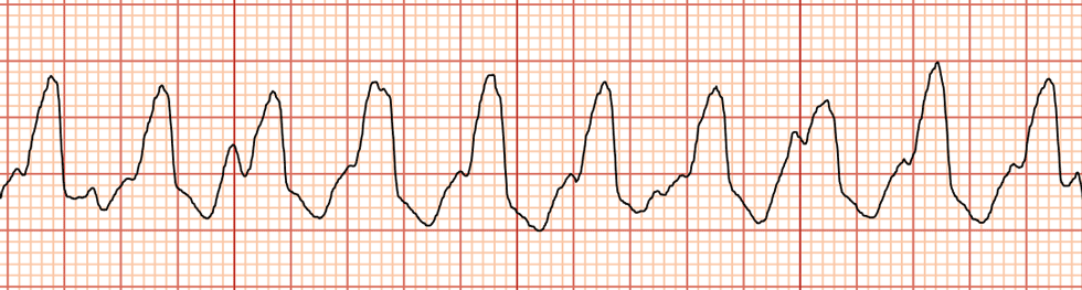 <p>rapid ventricular rhythm</p>
