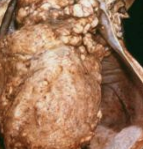 <p>What type of infection response is due to formation of granulomas usually from TB, higher-level bacteria, or fungi?</p>