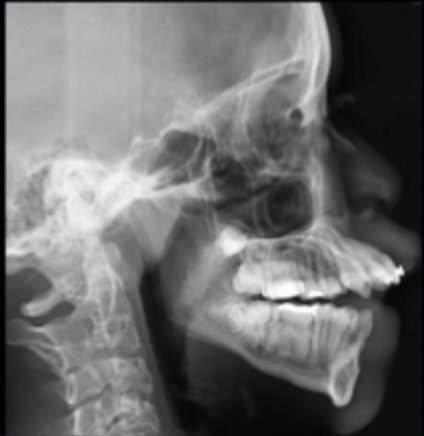 <p>what class of occlusion is shown in this x-ray? </p>
