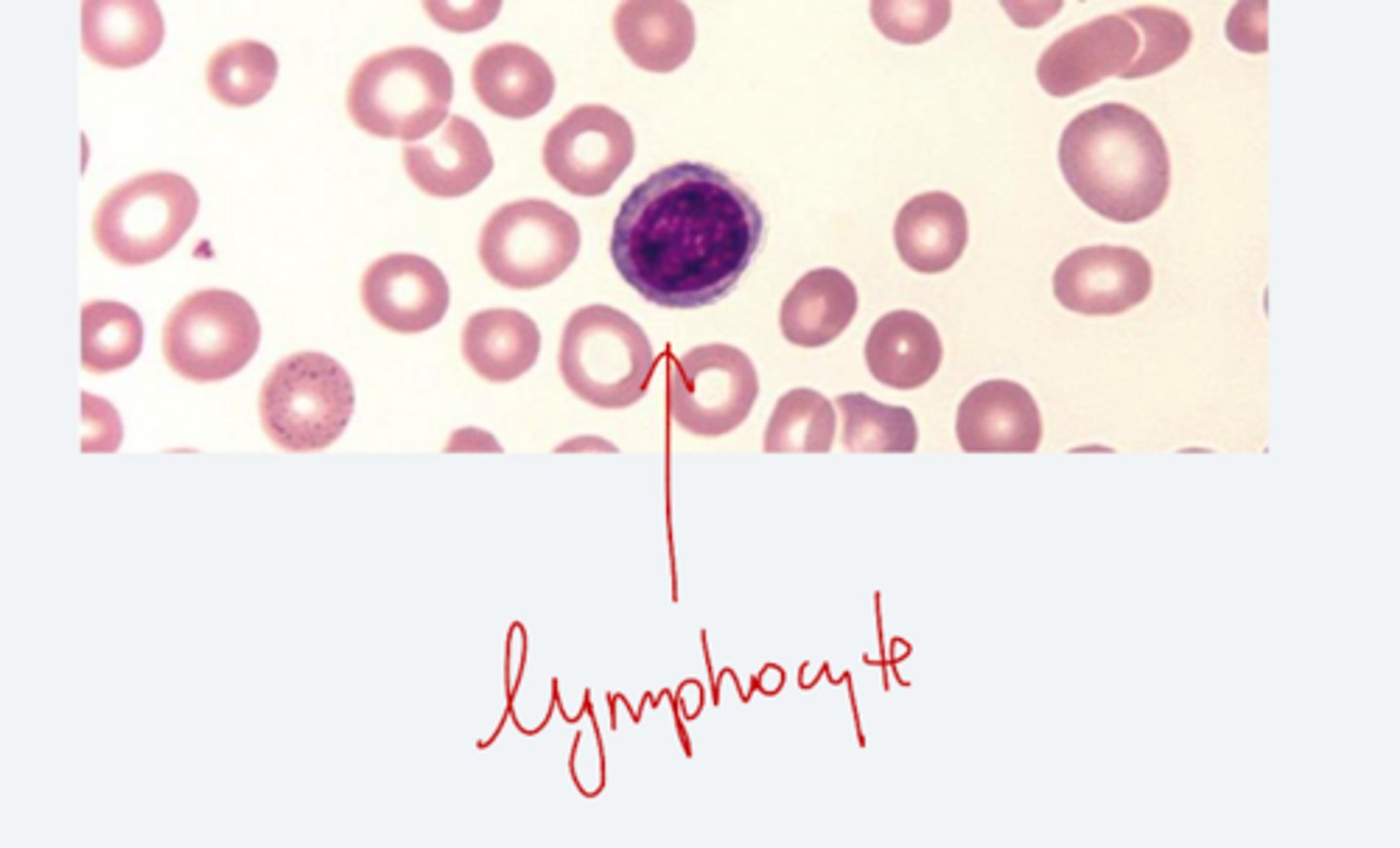 <p>1. smaller size as a lymphocyte nucleus</p><p>2. central pallow = > 1/3 cell diameter</p><p>3. cause: iron deficiency</p>