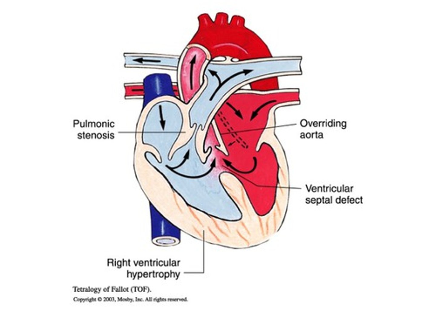 <p>large VSD</p><p>pulmonary stenosis</p><p>right ventricular hypertrophy</p><p>overriding aorta</p>