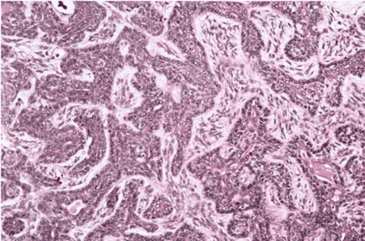 <p>Encapsulated, Islands with</p><p>palisaded cells, Jigsaw pattern, May form ducts</p>