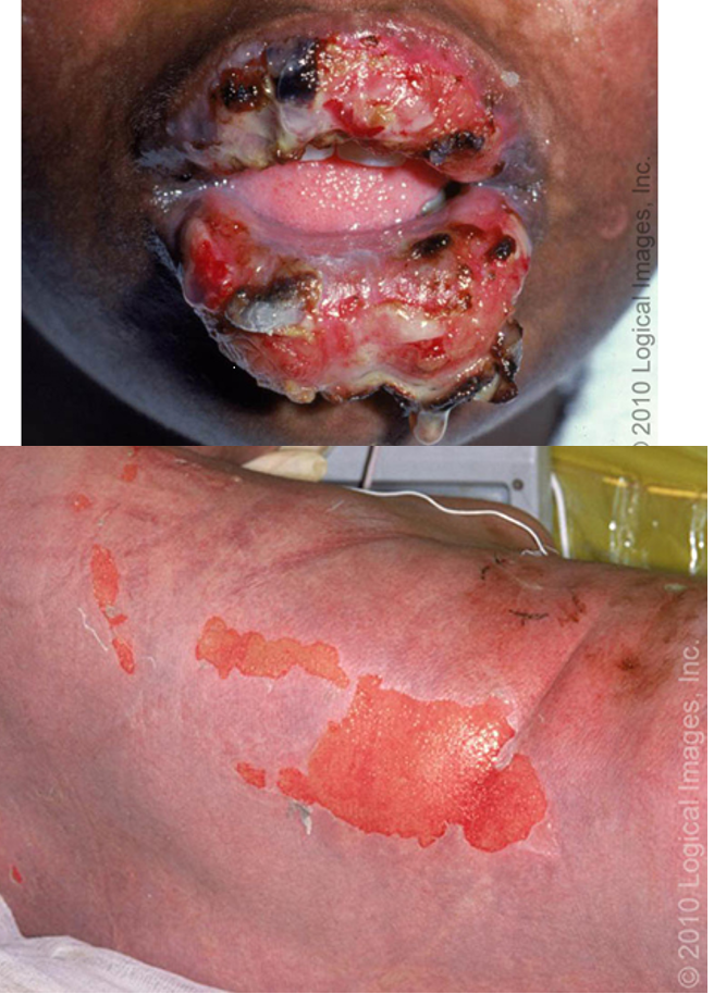 <p>tachycardia</p><p>positive nikolsky sign</p><p>erythematous macules, targeted lesions, or diffuse erythema progressing to vesicles and bulla</p><p>painful mucosal erosions</p><p>necrosis and sloughing of epidermis</p>