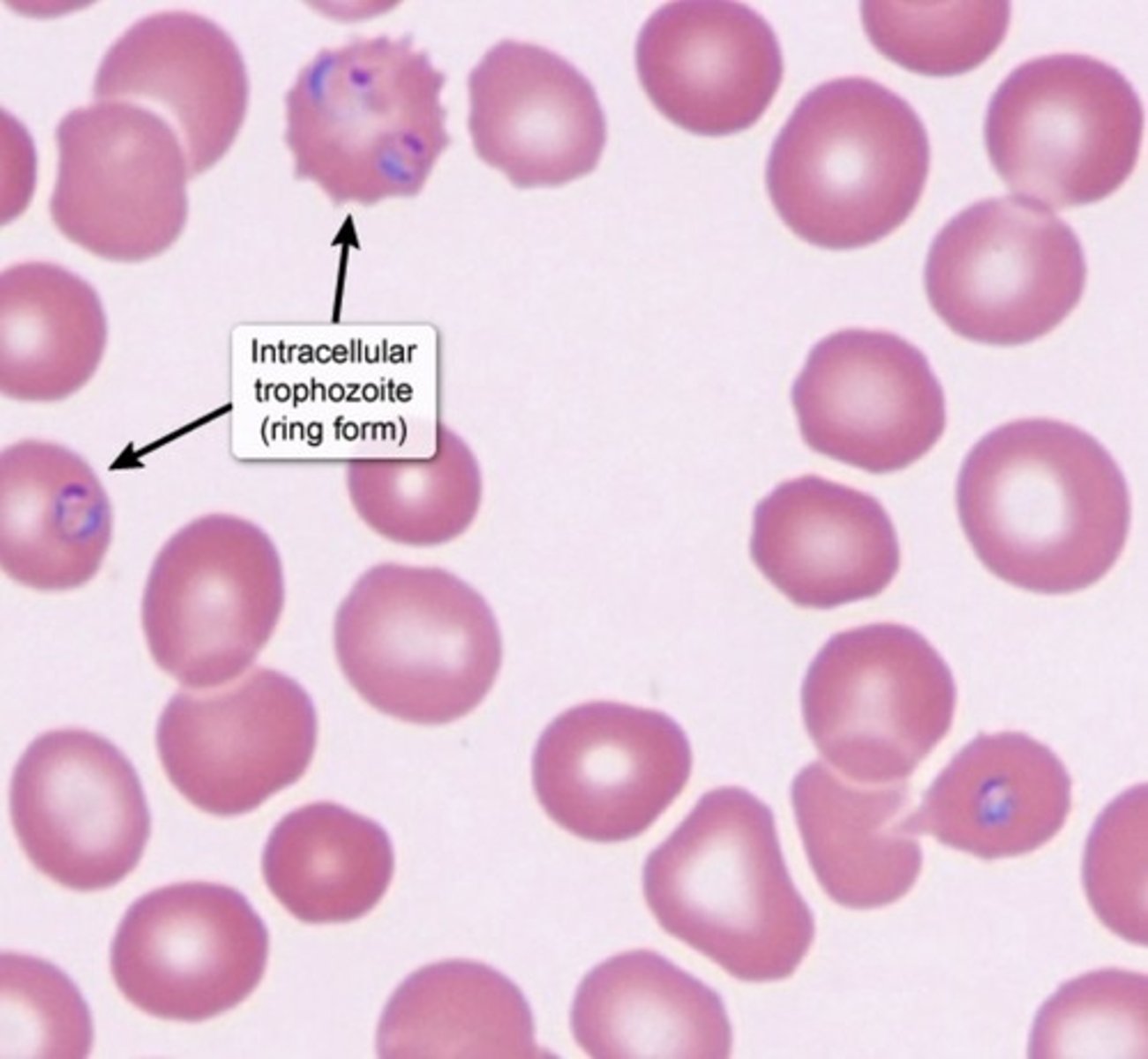 <p>Protozoa</p><p>Transmission</p><p>-Anoepheles mosquito</p><p>Histo</p><p>-Intraerythrocytic Ring inclusions in Giemsa stain</p><p>Sx</p><p>-Malaria (Myalgia + Fatigue + Headaches + Anemia + Hepatosplenomegaly + Indirect Bilirubinemia)</p><p>Tx</p><p>-Chloroquine (Targets Erythrocytic phase)</p><p>-Primaquine (Targets Hepatic Dormant phase)</p><p>**Dormancy occurs in the Liver**</p>