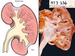 <p>-chronic, interstitial, intrarenal</p><p>-can become chronic and lead to chronic kidney failure</p><p>-persistent, recurrent infections of kidneys</p><p></p><p></p>
