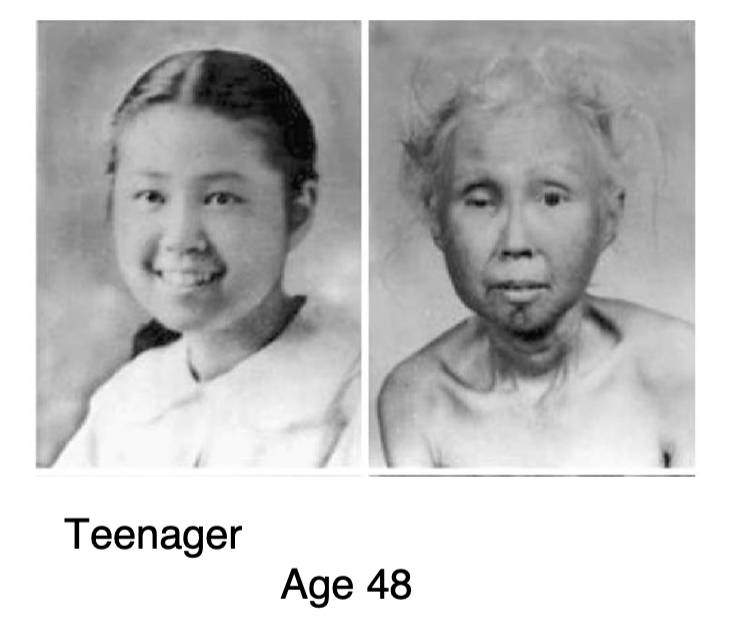 * condition that causes premature aging
* people with Werners typically develop and grow normally until puberty → at puberty, growth stops and adults with Werner syndrome are typically shorter than average → by early 20s-30s, ppl with this syndrome develop conditions usually associated with more advanced ages + ppl with Werners have an increased risk of developing cancer, especially thyroid and skin cancers
* heart attacks and cancer are the most common causes of death (most ppl with this condition die in late 40s to mid 50s depending on how well symptoms are managed + presence of other health conditions
* Werner syndrome caused by mutations in the WRN gene - condition diagnosed based on symptoms and genetic testing 
* **application of autosomal recessive inheritance** 