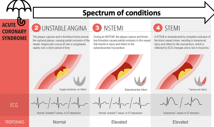 <p>describes a spectrum of clinical syndromes including</p><ul><li><p>unstable angina → normal, inverted T waves (ST depression), troponins are normal&nbsp;</p></li><li><p>non-ST elevation myocardial infarction (NSTEMI) → normal, inverted T waves (ST depression), roponins are elevated&nbsp;</p></li><li><p>ST elevation myocardial infarction (STEMI) → hyperacute T waves (ST elevation), troponins are elevated</p></li></ul><p>caused by thrombosis, leading to acute occlusion of a coronary artery , presenting as the spectrum of clinical syndromes</p><p></p>