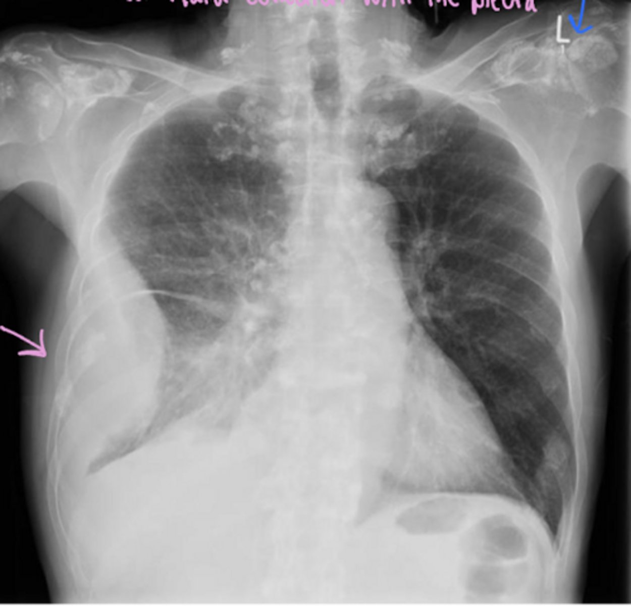 <p>What is this pattern of lung disease?</p>