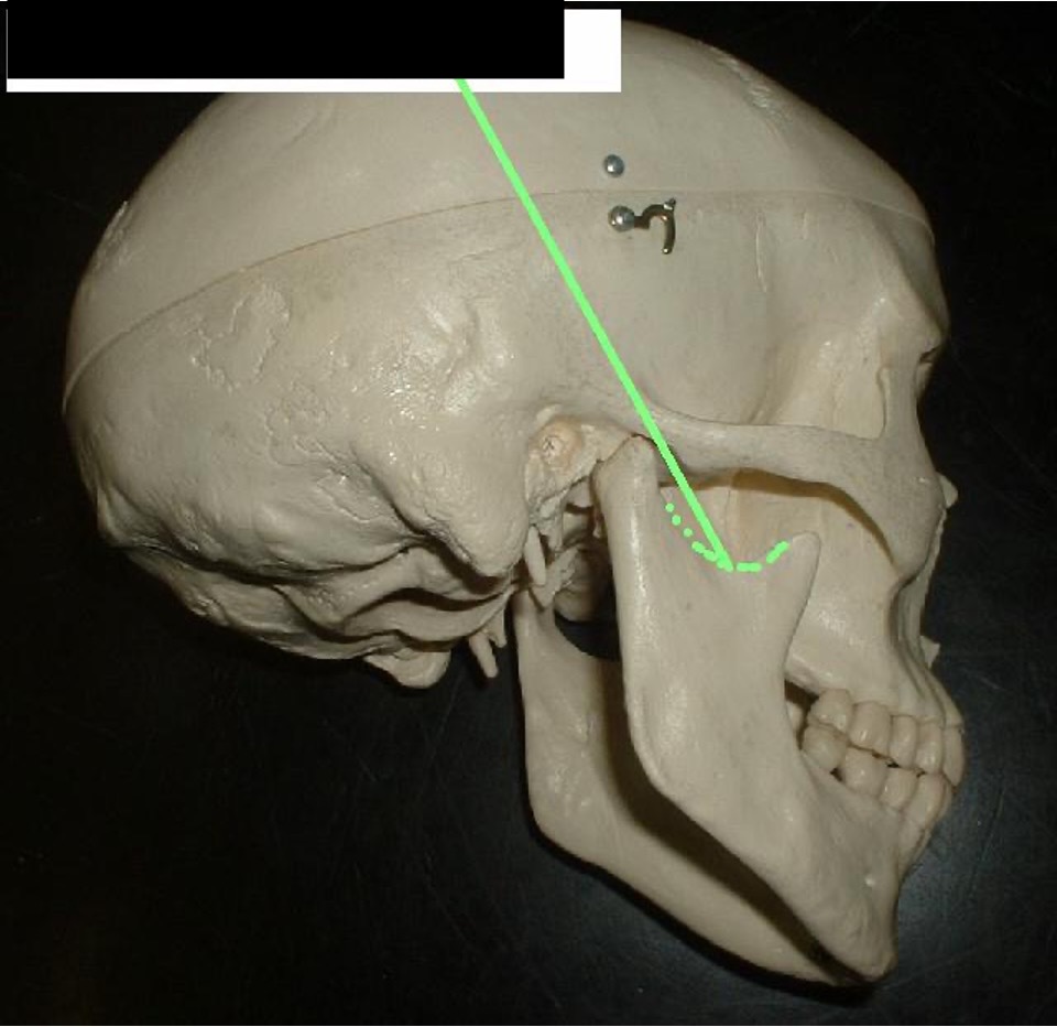 <p>A dent that is between the coronoid process and the condylar process.</p>