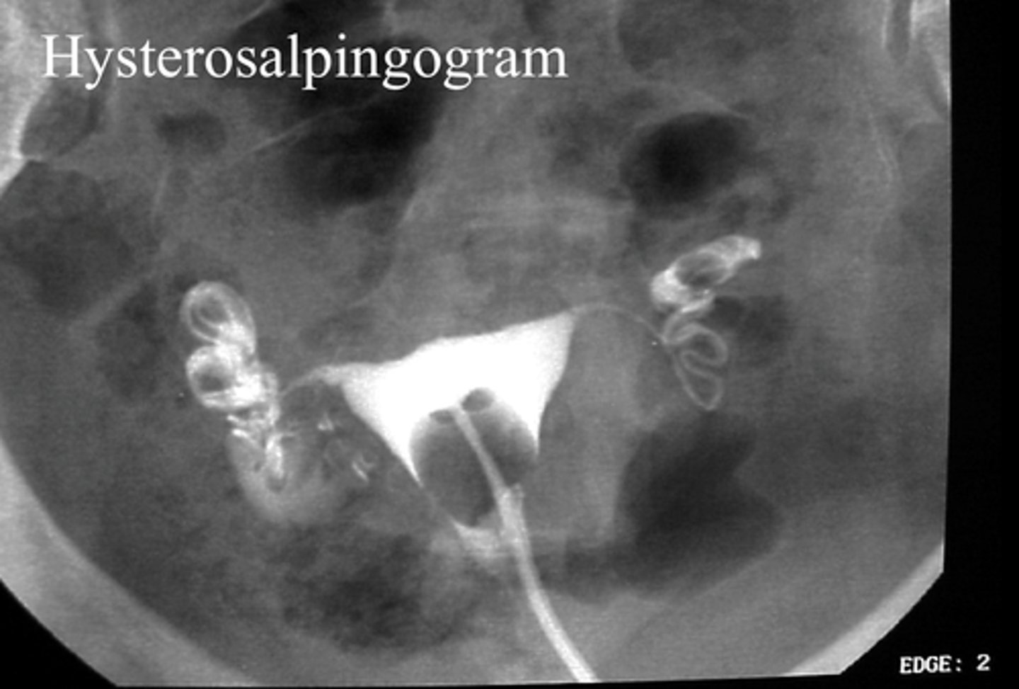 <p>x-ray film of uterus and fallopian tubes</p>