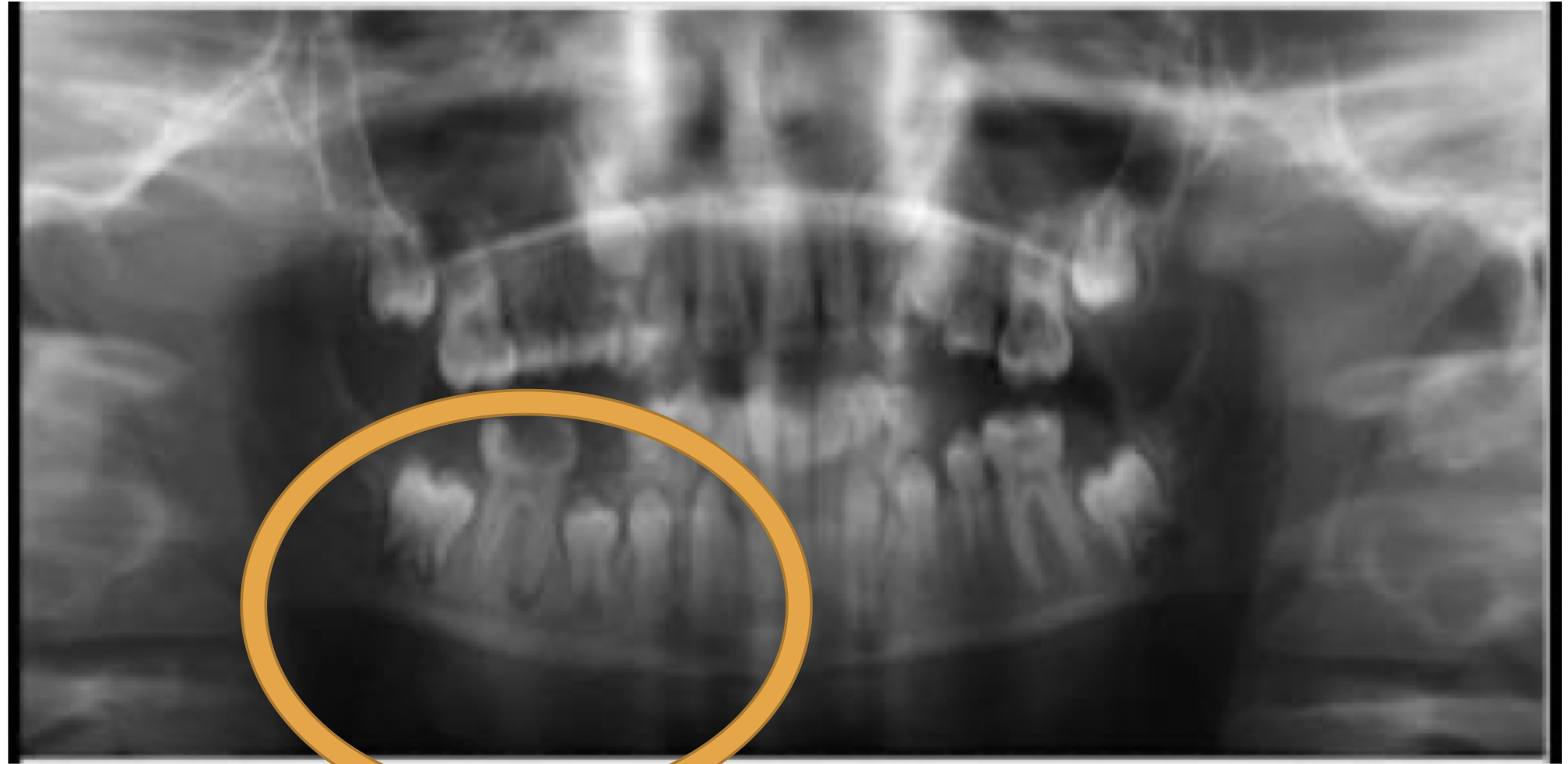 <p>A 9 year old with deep caries on 46 with mild pain. An OPG was taken and provided below</p>