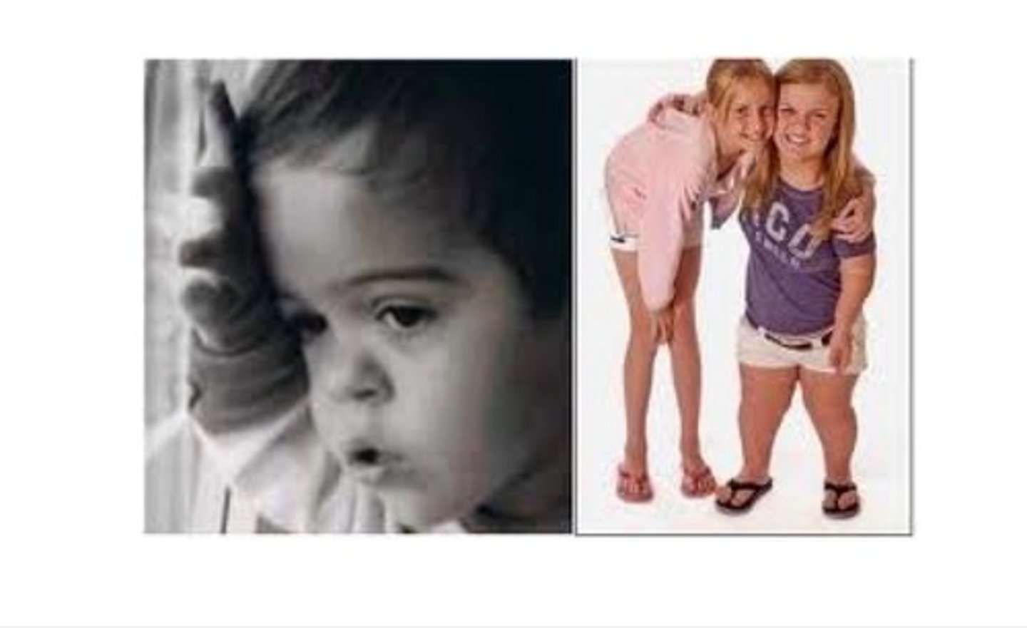 <p>Short limbs, deficient cranial base length (due to deficient growth of synchondrosis), mid face deficiency (due to lack of maxillary growth).</p>