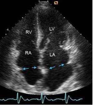 <p>You are scanning a patient and notice an odd portion of the image in the apical 4 chamber atria.&nbsp; What could it be?</p><p></p><p>Grating lobe artifact</p><p>&nbsp;</p><p>Transplant suture lines</p><p>&nbsp;</p><p>Thrombus</p><p>&nbsp;</p><p>This is an image of normal atria</p>