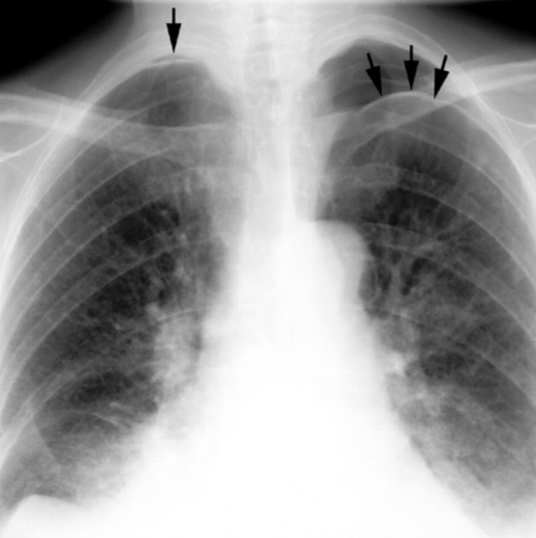 <p>air in the pleural space causing lung collapse. Seen as an area of no vascularity and a thin white line on CXR</p>