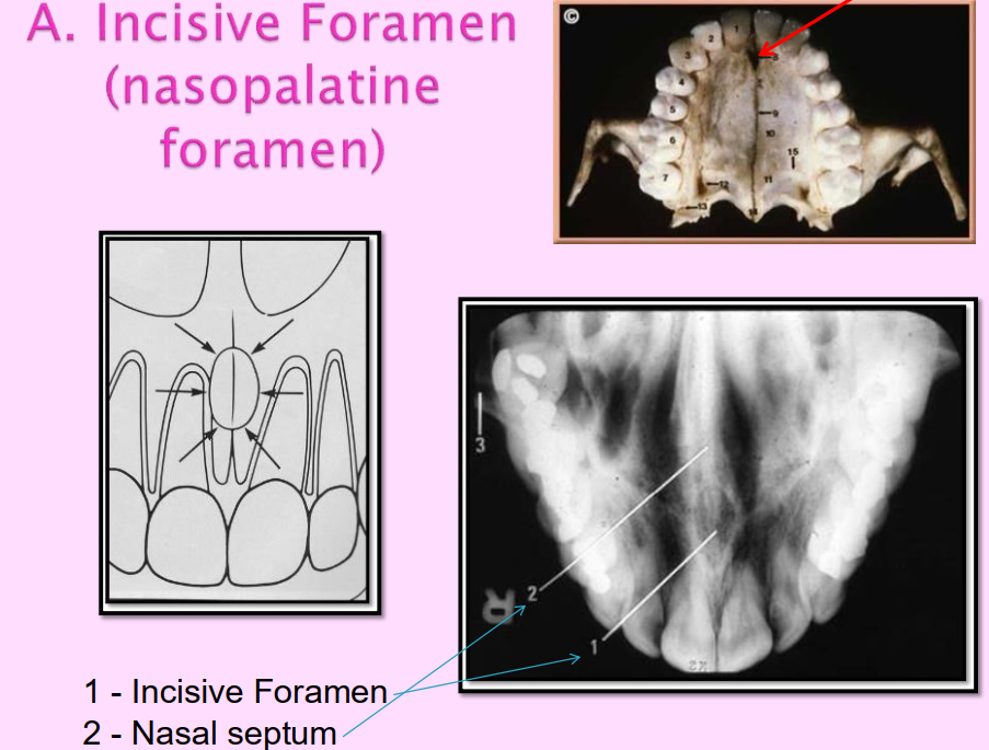 <p>Incisive foramen (nasopalatine foramen) </p><ul><li><p>Opening in the bone that is located midline of anterior portion of the hard palate, directly posterior to the maxillary central incisors </p></li><li><p><u>Radiography: small ovoid or round </u><strong><u>radiolucent</u></strong><u> area between the roots of the maxillary central incisors. </u></p></li></ul><p></p>